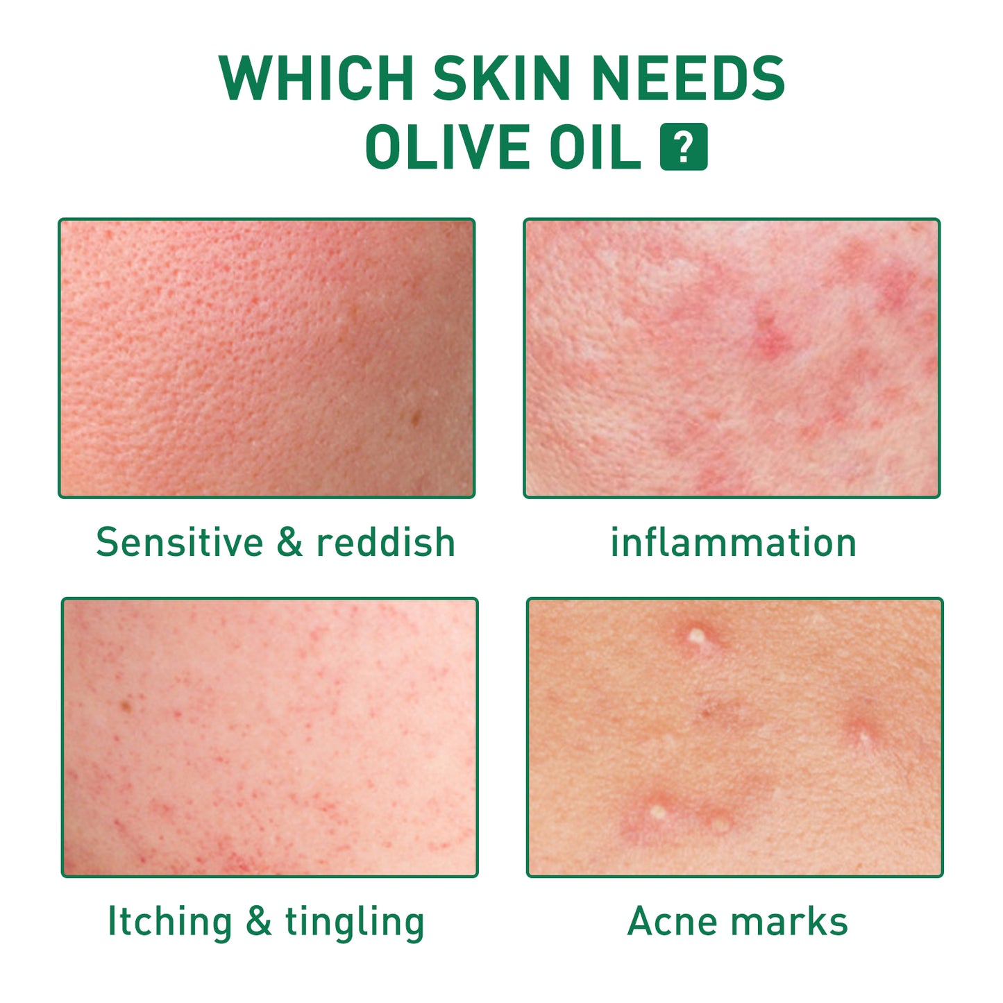 Tea Tree Oil Acne Serum, Remove Acne, Clear Acne, Repair Skin, Lighten Acne Printing Face Essence